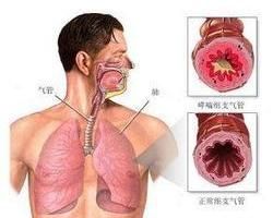 內源性哮喘