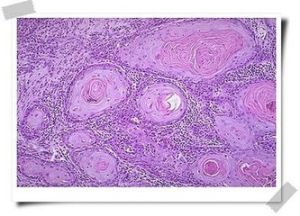 宮頸鱗狀細胞癌顯微鏡圖