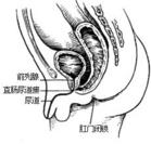 先天性直腸肛管畸形