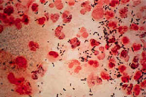 慢性前列腺炎--淋球菌