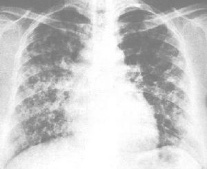 （圖）肺泡