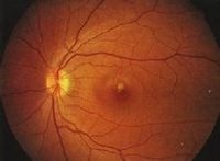 視網膜動脈硬化
