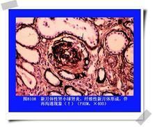 新月體性腎小球腎炎 