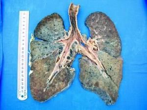 煤工的塵肺標本