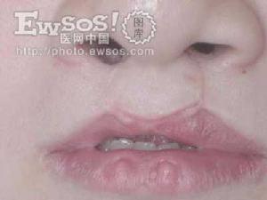 先天性畸形——唇齶裂