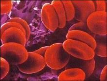 老年真性紅細胞增多症