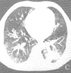 支氣管腺瘤