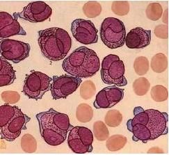 早幼粒細胞白血病