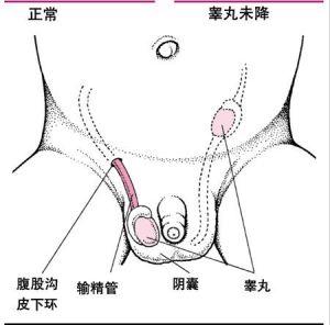 隱睪症患者的陰囊一側或雙側較小，右側多於左側，觸診陰囊內無睪丸，在腹股溝管內常可摸到小睪丸，部分位於腹膜後可完全觸不到，隱睪常伴有腹股溝斜疝。