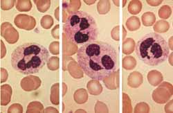 （圖）幼年型慢性粒細胞白血病
