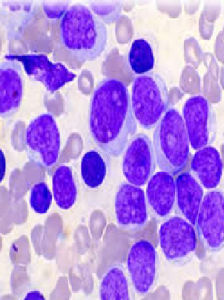 急性早幼粒細胞白血病