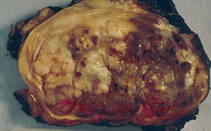 軟組織腫瘤