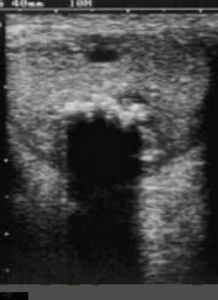 表皮樣囊腫 表皮樣囊腫