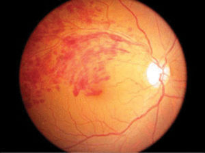 糖尿性視網膜病 