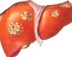 肝腫瘤