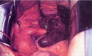 輸卵管結紮術後外側殘留段扭轉，導致出血性梗死