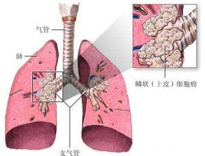 中心型肺癌