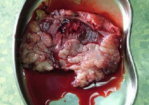 膀胱腫瘤