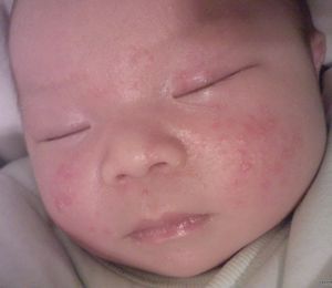 新生兒濕疹