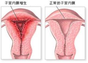 子宮內膜厚