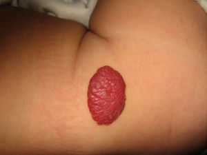 草莓狀血管瘤