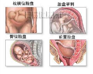 胎盤早期剝離