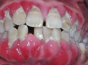 牙齦腫脹