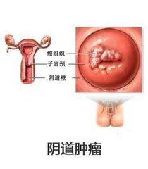 陰道惡性腫瘤