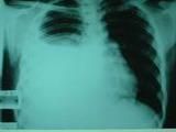 砷肺癌