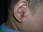 耳部濕疹症狀