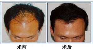種植頭髮術前和術後對比