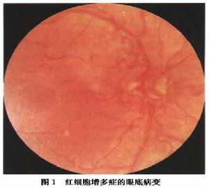 紅細胞增多症視網膜病變