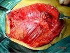 腎盂腫瘤和輸尿管腫瘤