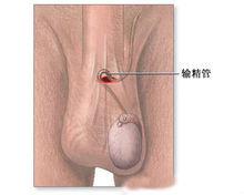 男性輸精管結紮手術部位示意圖