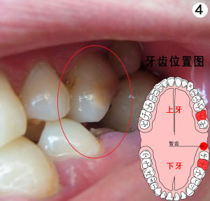 牙齦息肉表示