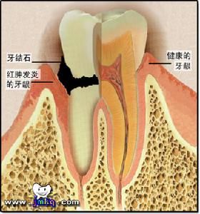 老年性牙周炎 