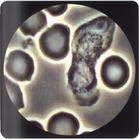 幼年型慢性粒細胞白血病