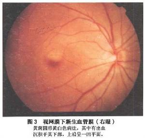 視網膜下新生血管膜