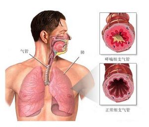 哮喘患者的支氣管與正常人支氣管示意圖