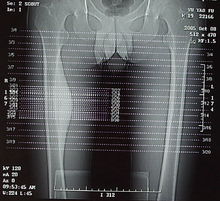 大腿的X光片