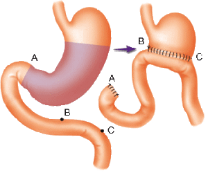 食管反流性胃炎