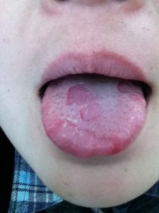 舌爛