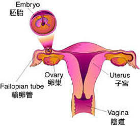 宮外孕