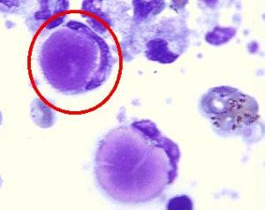 紅斑狼瘡細胞
