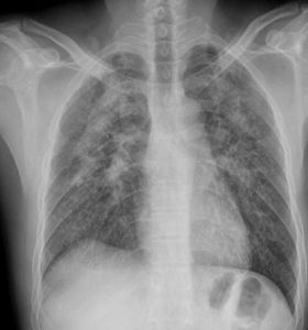 典型矽肺胸片