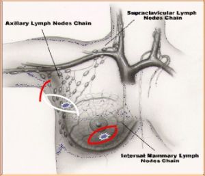 預防性乳房切除術 預防性乳房切除術
