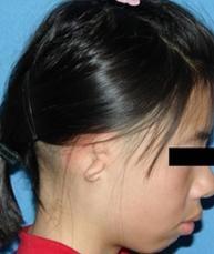 先天性小耳畸形 先天性小耳畸形