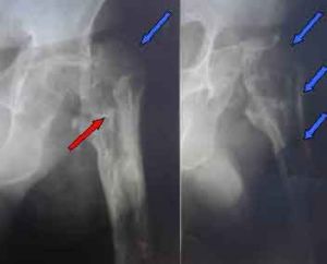 醫源性骨髓炎 醫源性骨髓炎