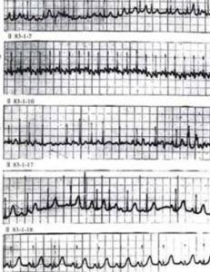 室上性心動過速 室上性心動過速
