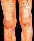 紅皮大皰型魚鱗病 紅皮大皰型魚鱗病